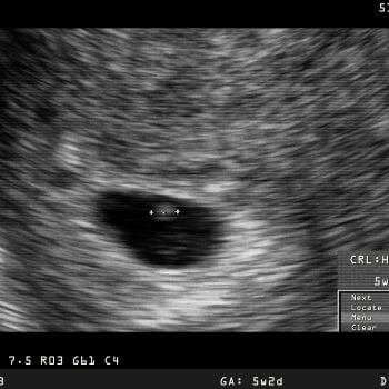 Pre Pregnancy
